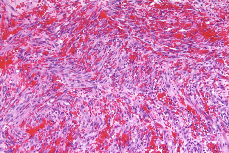 Video: Living with Cancer, Kaposi’s Sarcoma