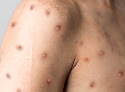 Monkeypox is a virus that causes disease in humans and animals. Common monkeypox symptoms include fever and skin lesions. There is no cure for monkeypox, but some antiviral drugs may be effective in treating the disease.

