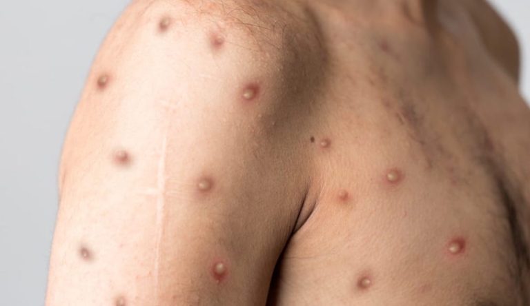 Video: Mpox – Both U.N. and World Health Organization Respond