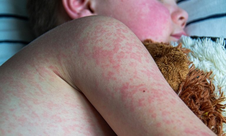 More States Report Measles Outbreaks Amid Anti-Vaccine Narratives